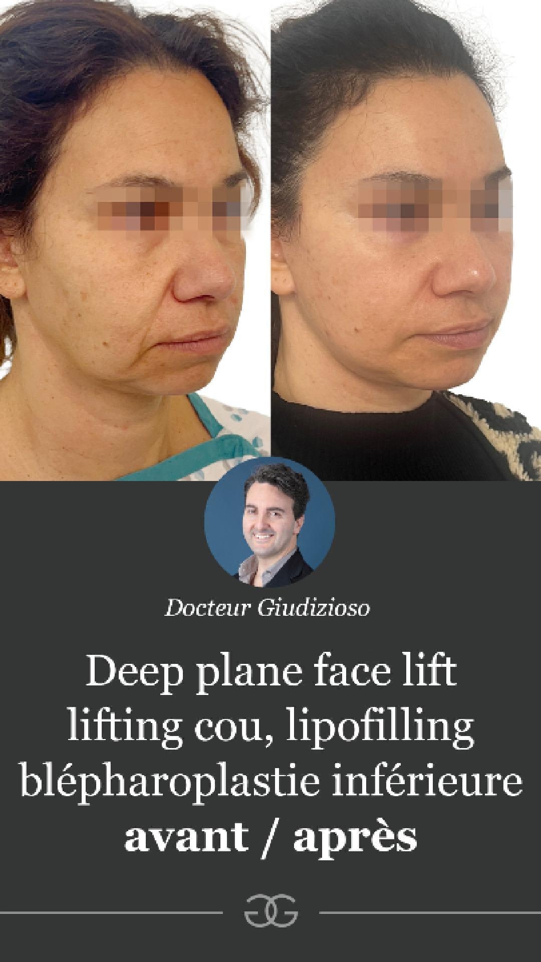 Rajeunissement complet du visage : quand la chirurgie agit en profondeur