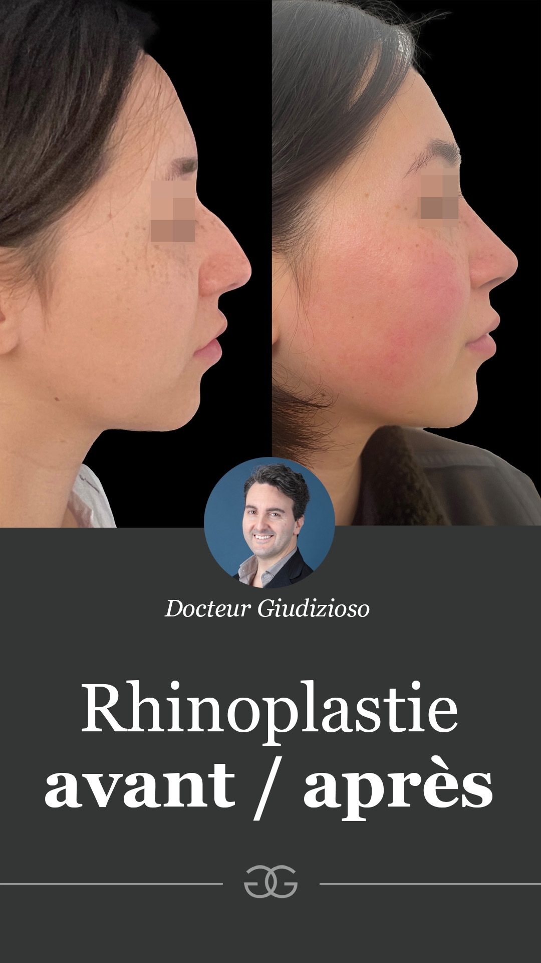Rhinoplastie de pr&eacute;servation : une approche moderne pour un r&eacute;sultat naturel